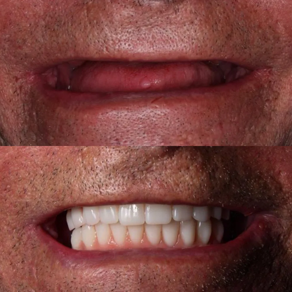 Antes e depois de tratamento com prótese fixa: boca sem dentes e sorriso recuperado com dentes fixos